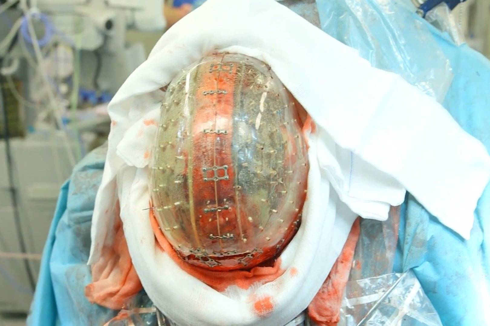 Lekarze zastąpili pacjentce fragment czaszki wydrukiem 3D